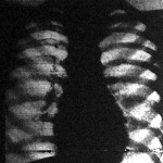 Szív a bordák között röntgenfényben