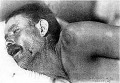 Meningitisben szenvedő beteg Meningitisben szenvedő beteg