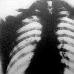 Mellkas Röntgen-fotoja