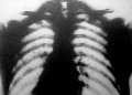 Mellkas Röntgen-fotoja